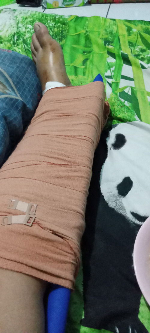 Jatuh kaki kekilir sampai retak sedikit bentar LG hpl sedih bgt , kira kira bisa ngga ya lahiranny,