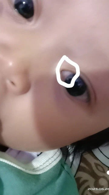 Bun sharing dong bayi saya 7bulan di sclera matanya kayak ada garis merahnya di dekat kornea mata
