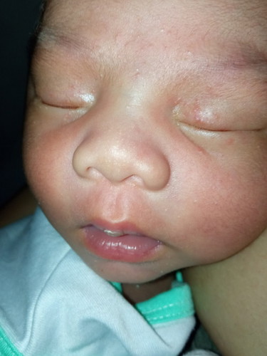 rashes sa eyelids ni baby