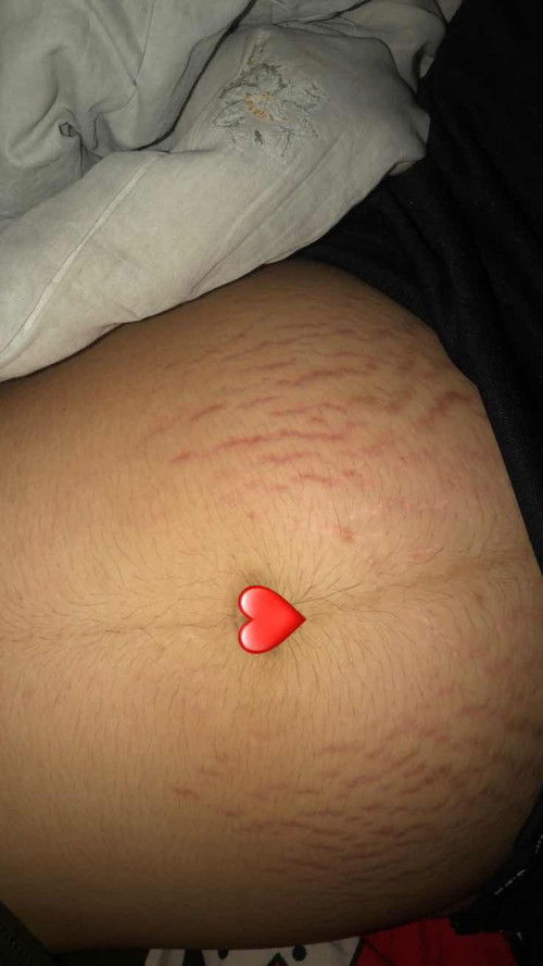 ท้องเราแตกลายหนักมาก