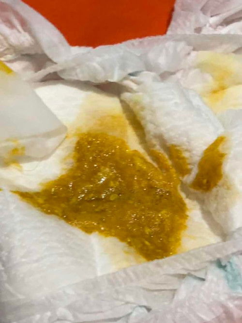 Pup / feses bayi berbusa bahaya?