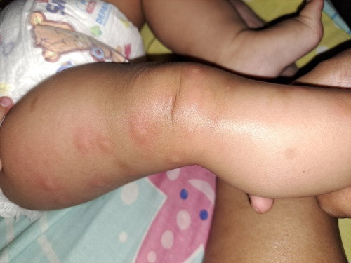 Kesel bgt anakku digigit nyamuk smpe 17 bentol