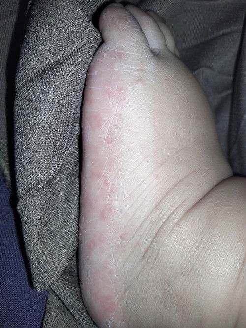 Bintik bintik pada kaki bayi 7bulan