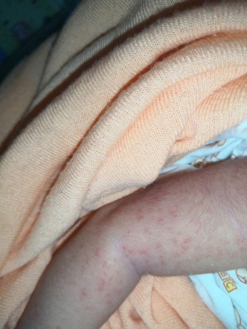 ทำยังไงผดแดงๆจะหายคะ