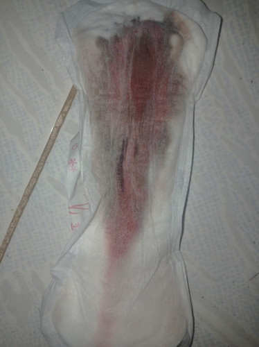 Tanong lang po ung asawa ko po kasi ay dinugo pero nag positive sya sa blood cerum