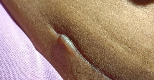 JAHITAN PASCA OPERASI CS SAKIT