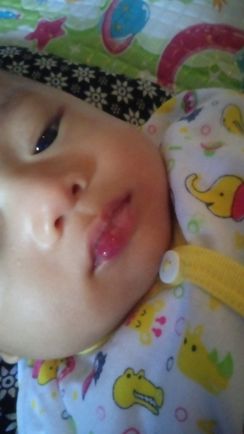 Hemangioma