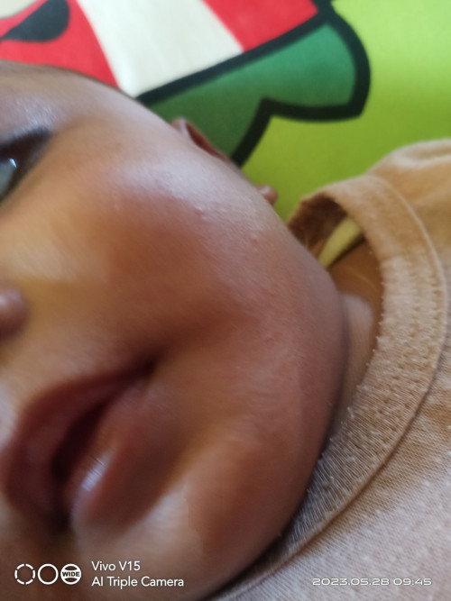 Bintik" di wajah bayi