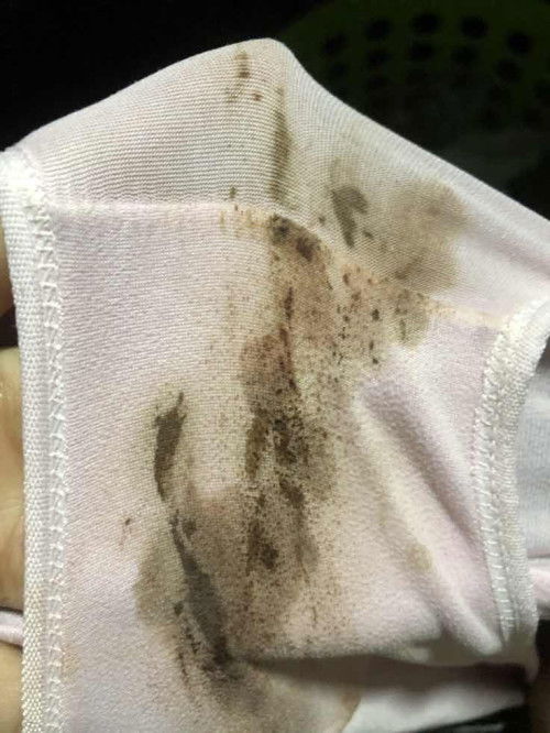 สอบถามแม่ๆหน่อยค่ะ ตกขาวสีน้ำตาล