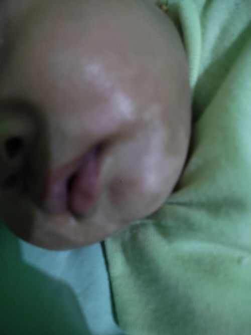 Mom ada yang pernah ngalamin bayinya abis bentol-bentol pas sembuh jadi putih gini gak ya??