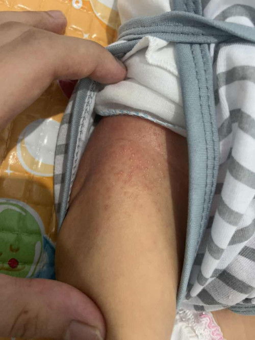 solusi bintik merah/ruam newborn