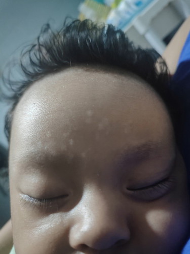 Normal lang po ba ito wla nmn sya nyan nun newborn. Mukhang an an.Ano gamot Dito salamat mga mima