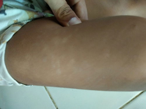 Bintik kecil seperti panu