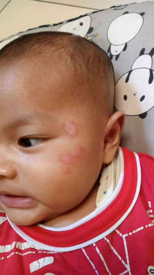 Maaf bunda" mau tanya apakah ini herpes ya awalnya kena biang keringat lama" ada ruam kayak gitu