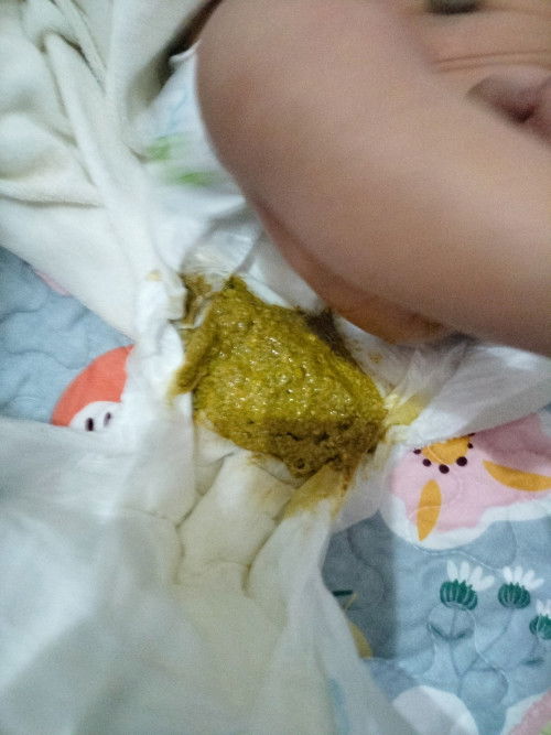 ถ่ายอุจาระ