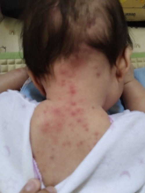 Gatal2 pada bayi 2 bulan