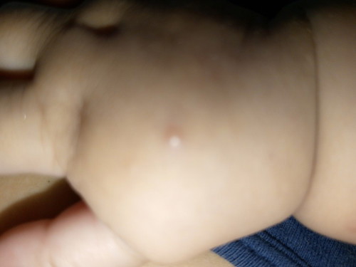 Ask kolg po sa mga mommy na nag karoon din yung baby nila nito