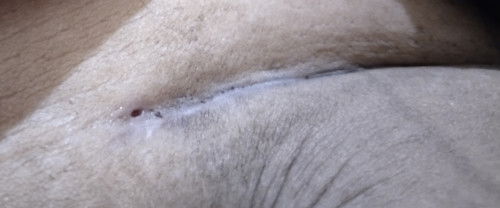 Luka sc bolong setelah 5 bulan