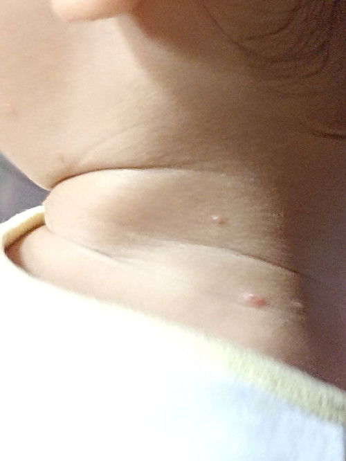 Seperti cacar air pada anak