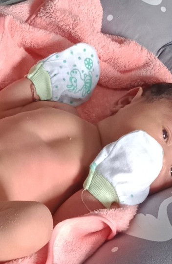 Cekungan di dada bayi