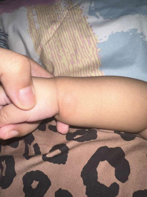 digigit serangga atah nyamuk?