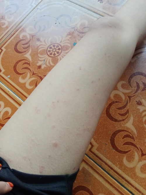 Permisi bun iszin bertanya ada yg ngalami gatal" saat 30 week begini kah bun?