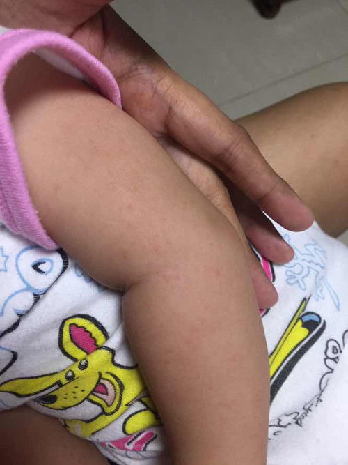 RASHES? Bungang araw?