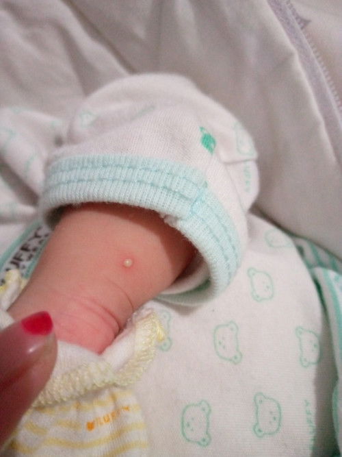 Kulit bayi bintik merah bernanah