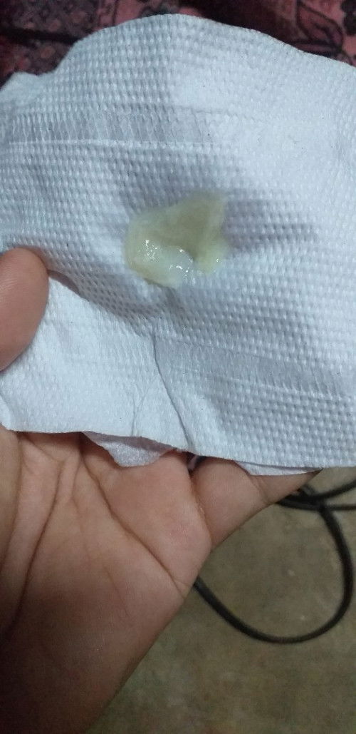 เเม่ๆค่ะ เเบบนี้ตกขาวหรือว่ามูกค่ะ