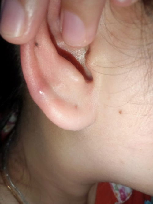 Benjolan daun telinga