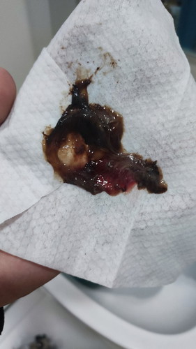 Mucus plug ?
