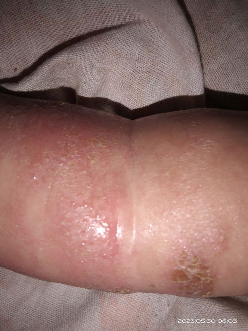 Solusinya dong bunda2 anakku tangannya merah kadang mengeluarkan seperti getah gitu,apa obatnya ya