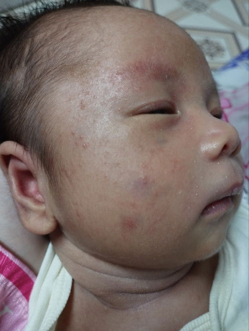Em bé 25 ngày tủôi, nổi mẩn đỏ