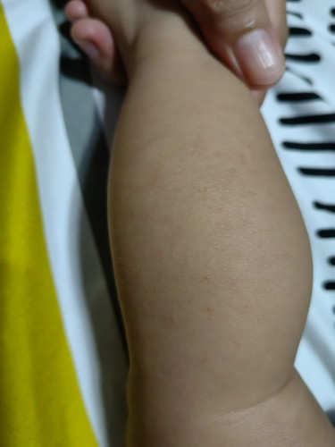 Rashes or anu po kaya ito?