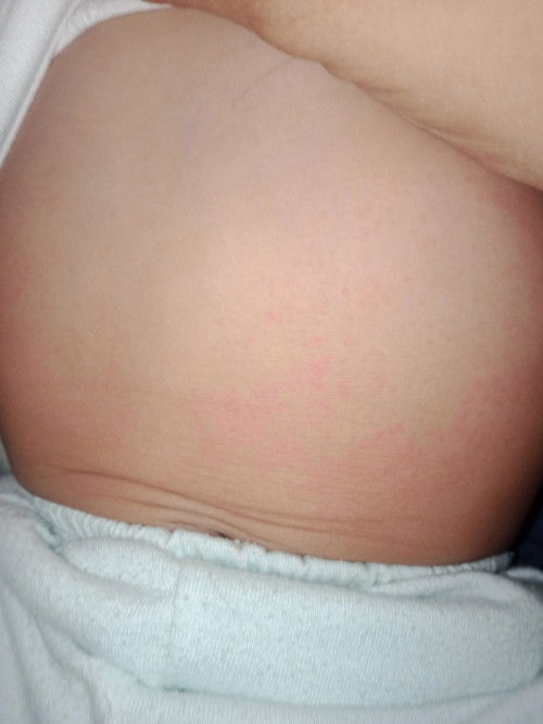 Bungang araw po kaya ito?