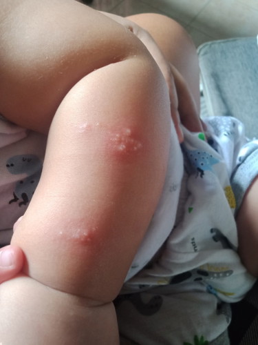 Kgat ng lamok or rashes