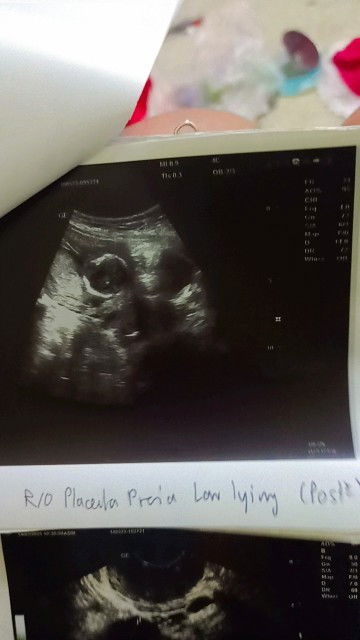 ภาวะรกเกาะต่ำ