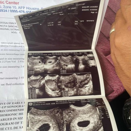 Firs time pregnant.