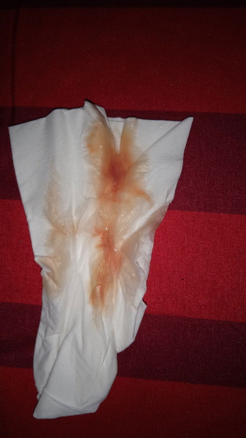 Flek darah campur lendir