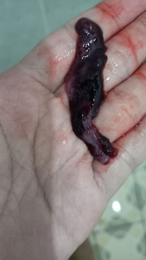 Kenapa Keluar flek hingga gumpalan darah di usia 6 minggu