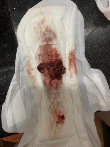 มีก้อนเลือดหลังคลอด