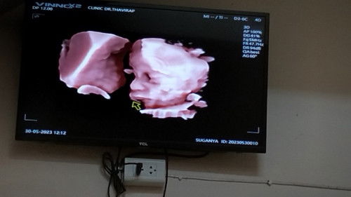 อัลตร้าซาวด์4มิติเห็นชัดมากคุณแม่ไปซาวด์กันหรือยังค่ะอยากเห็นหน้าลูกชัดๆแบบนี้ต้องไปนะคะ #ทีมสิงหาคม