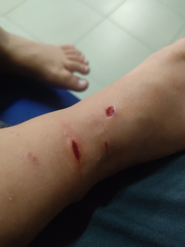 Boleh bgi tips ubat apa supaya cpt sembuh Luka..kena gigit kucing liar