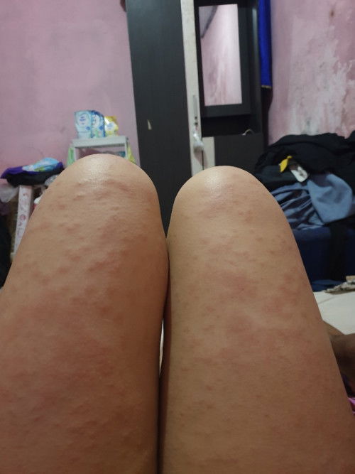 Bun ada yg ngalamin kaya gini? Katanya nama penyakitnya pupp, tapi super gatal tipsnya pake apa yah?