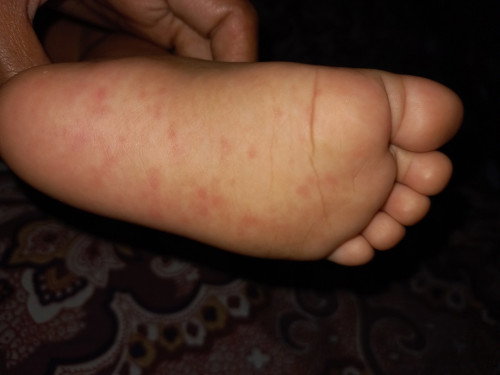 Gatal pada telapak kaki pada bayi  11 bulan