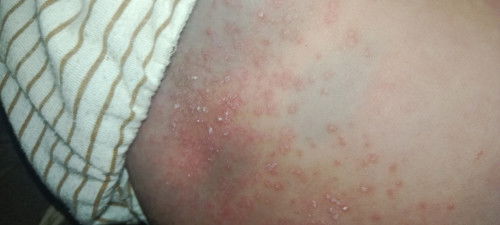 Apa ini biang keringat