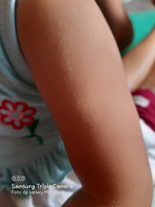 Bun kulit tangan anakq sprt ini ada bentol kecil2 tapi gak gatel kira2 knpa ya???