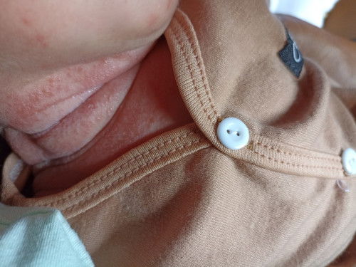 Cara ngilangin ruam berair pada lipatan leher bayi