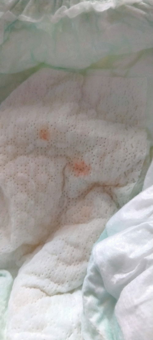 Có bé nào của mom bị như này ko ạ