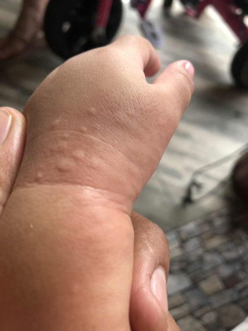 Alergi susu? rekomendasi susu